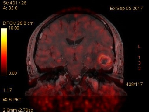 Coronal